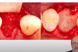 Dr. Farhad Boltchi explains the double membrane socket graft.