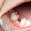 Missing Tooth Space Pixie Me
