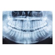 Panoramic Xray