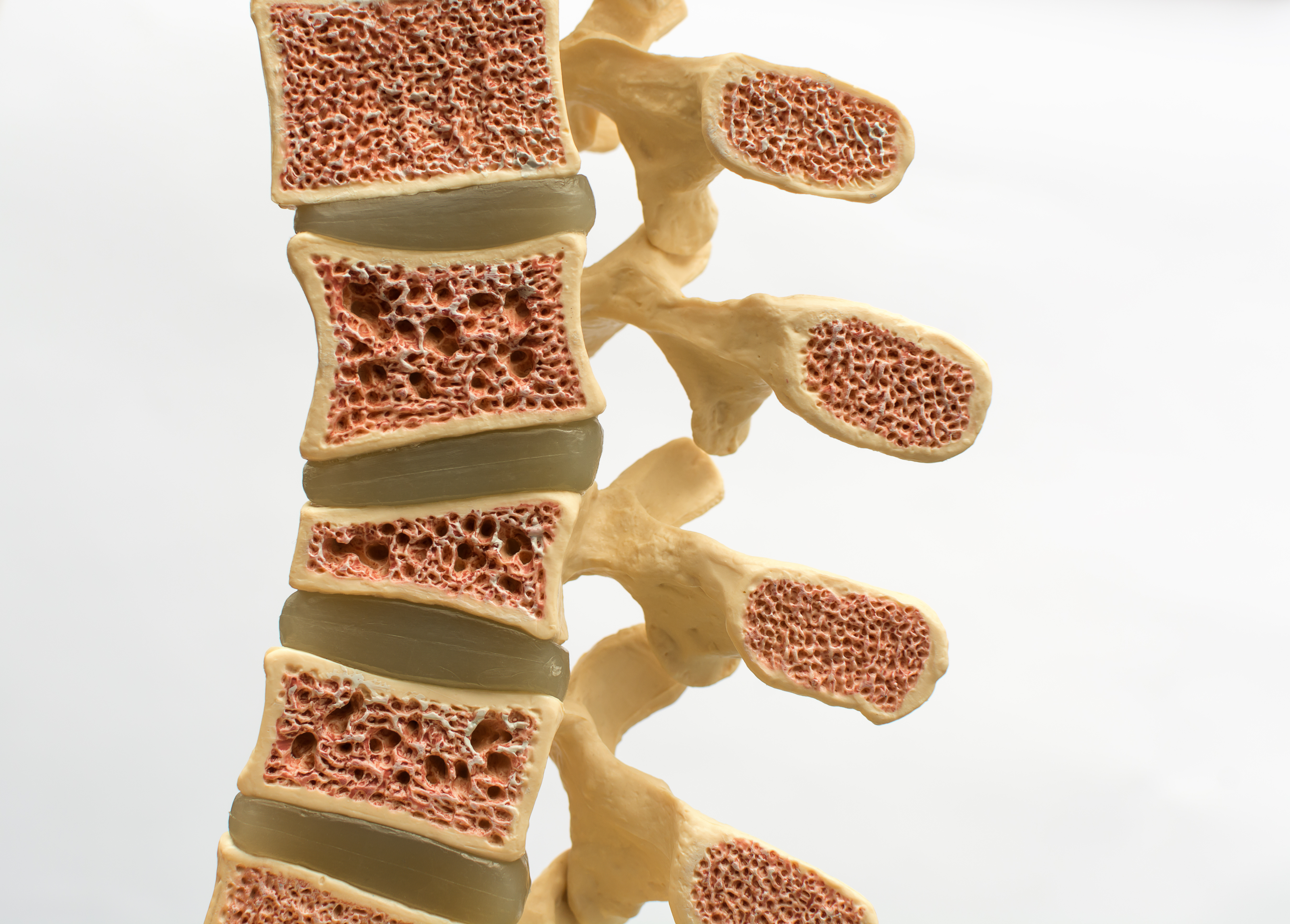 Spine Osteoporosis Leesle