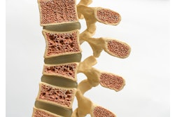 Spine Osteoporosis Leesle