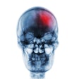 Stroke Skull Xray