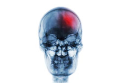 Stroke Skull Xray