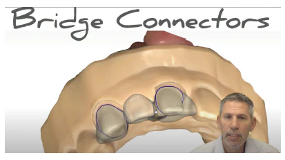 Clinical tip: What you need to know about a bridge connector ...