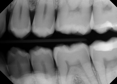 Figure 1: Preoperative bitewing showing primary decay on the distal of tooth #12 and the mesial of #13. Images and captions courtesy of Dr. Ben Alvarez.