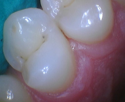 Figure 2: Pre-operative intraoral photo.