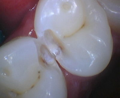 Figure 3: Unfinished preparation photo showing decay into the dentin.