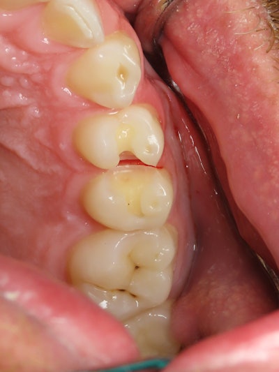 Figure 4: Final preparations before the restorations.
