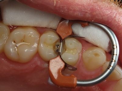 Figure 5: Restoring adjacent Lesions with the Halo Matrix, which show adequate contour and great sealing at the gingival margin.