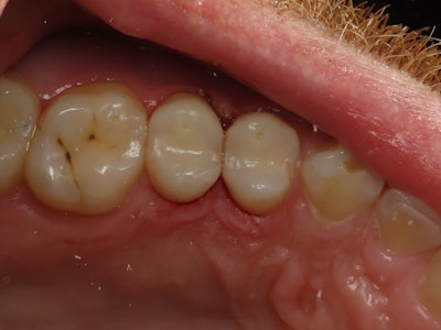 Figure 6: Direct final restorations after polish. Note the adequate contours and broad contact zone.