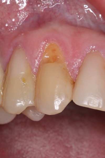 Figure 1: Initial presentation of tooth #6 showing the class V lesion with dislodged previous restoration and exposed dentin. Images and captions courtesy of Kuraray Noritake Dental Inc.