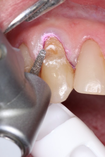 Figure 4: Preparation of the lesion completed with a diamond bur and starburst beveling pattern to enhance aesthetic blending.