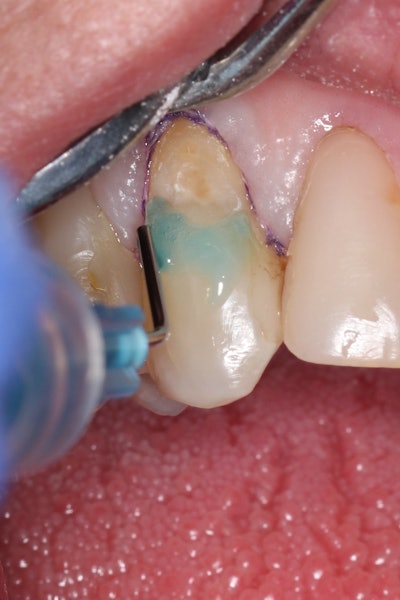 Figure 5: Selective etching of the enamel at the margins.