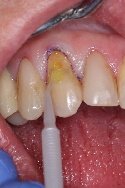 Figure 6: Application of Clearfil Universal Bond Quick 2 following selective etching of the enamel margins.