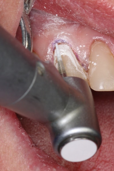 Figure 9: Initial contouring and shaping of the restoration using a fine-grit diamond bur.