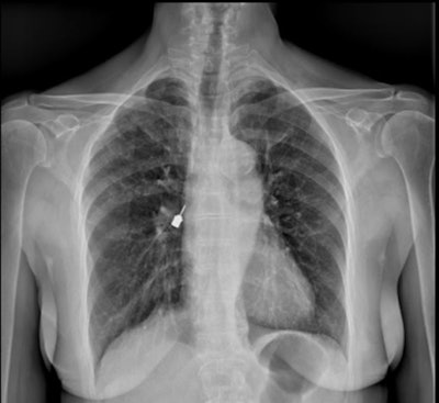 Figure 1: Posteroanterior chest x-ray. A metallic foreign body (the drill head) is visible near the right hilum, supposedly located in the right airways. Images and captions courtesy of De Chiara et al. Licensed under CC BY-NC-ND 4.0.