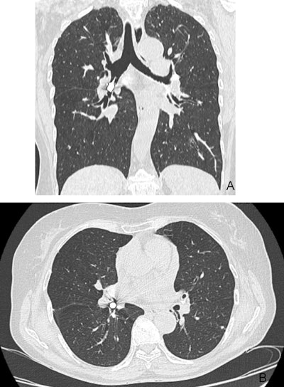 Figure 2: Thoracic CT scan showing the drill head located in the right intermediate and right lower bronchi. (A) coronal view (B) axial view.
