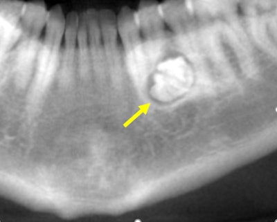 Figure 1: Reformatted CBCT panoramic film.