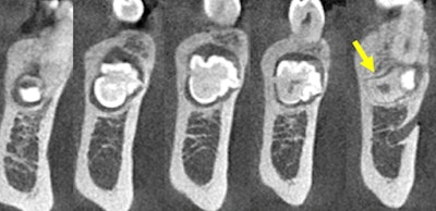 Figure 2: CBCT coronal projections (anterior to posterior).
