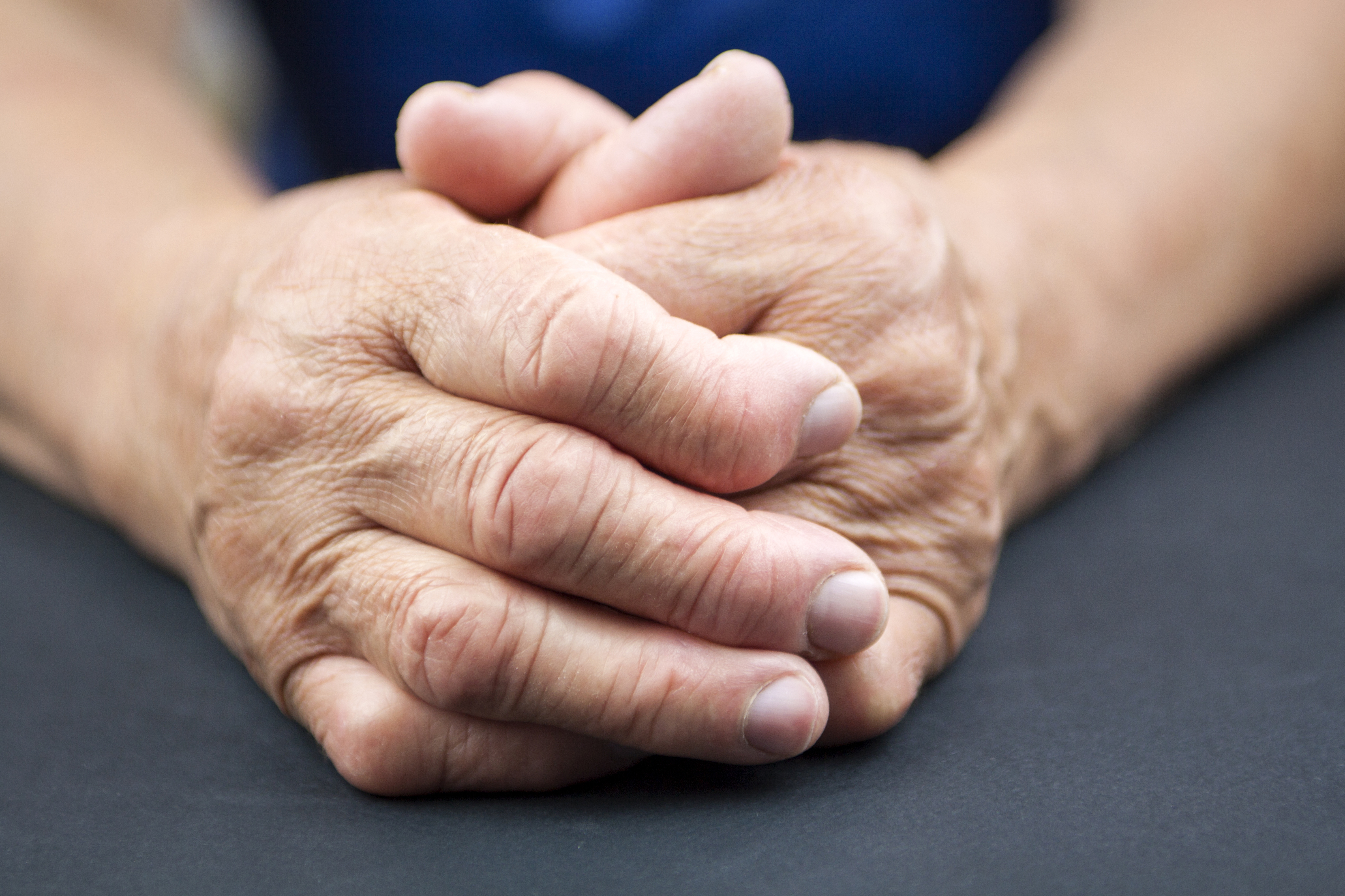 Hands Arthritis Rheumatoid
