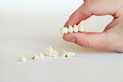 Porcelain Crown Bridge