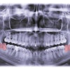 Third Molar Kabardins Photo