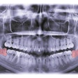 Third Molar Kabardins Photo