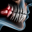 Third Molar Peterschreibermedia