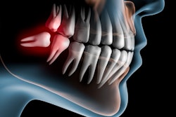 Third Molar Peterschreibermedia