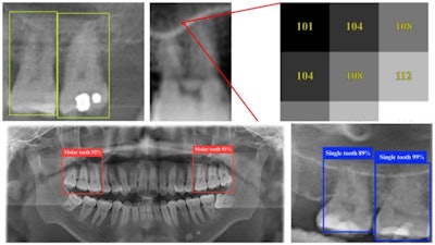 Sample dental panoramic radiographs as seen by the YOLO 11n deep learning model, which can identify tooth structures with up to 98.2% accuracy. Image and caption courtesy of Pei-Yi Wu et al. Licensed under CC BY-NC-ND.