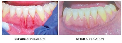 Before and after application of ClearDefense in one patient. Image and caption courtesy of Young Innovations.