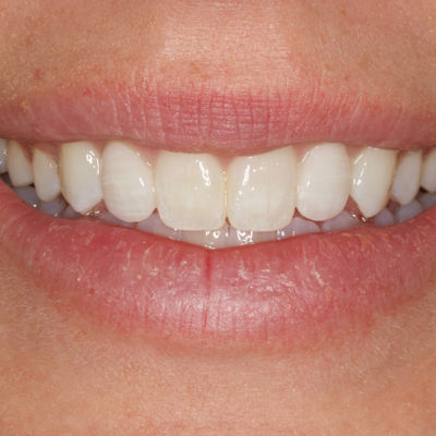 2025 04 Catapult Shofu Supersnap 400