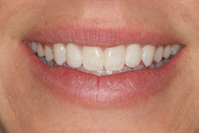 Figure 6: Post-op smile.