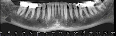 Figure 1: Reformatted and cropped panoramic film. All images courtesy of Dr. Juan F. Yepes.