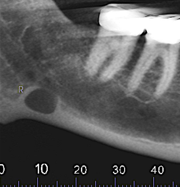 Figure 2: Reformatted and cropped panoramic film.