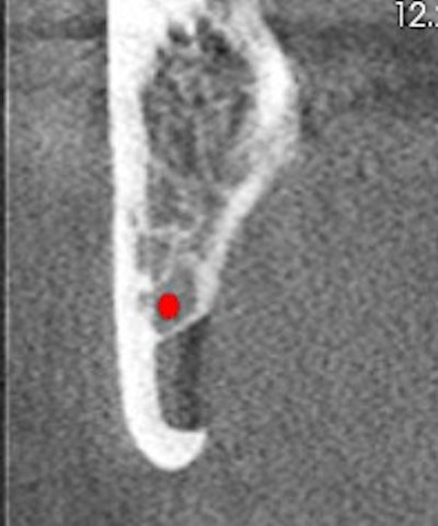 Figure 3: Coronal view of the posterior right mandible (the inferior alveolar canal is highlighted by red dot).