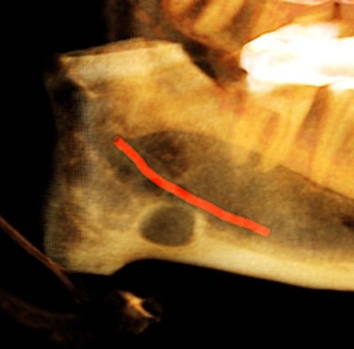 Figure 4: Coronal view of the posterior right mandible (the inferior alveolar canal highlighted in red) and 3D-reconstructed image of the posterior right mandible.
