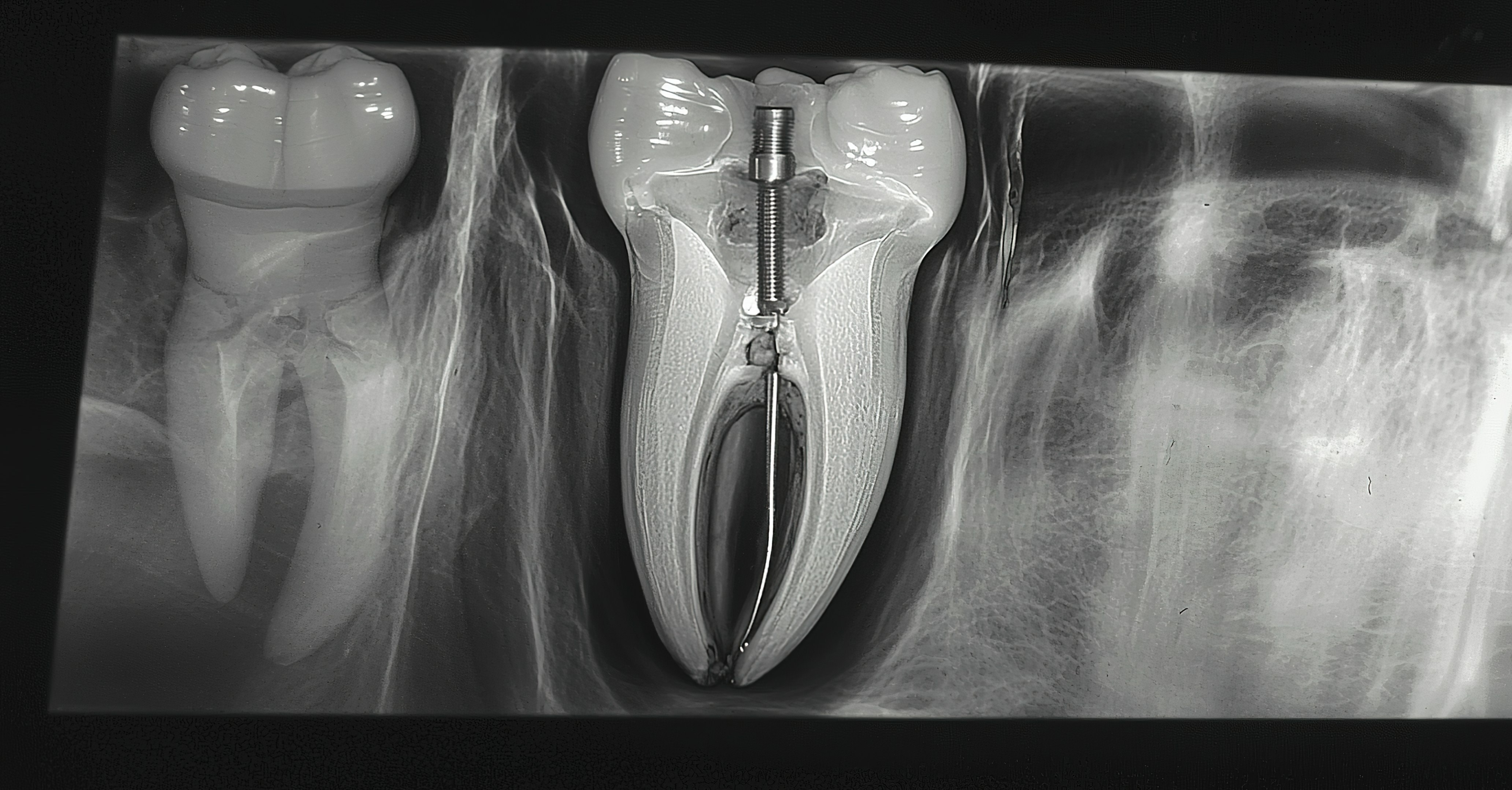 Xray Tooth Metal Post Byai