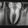 Xray Tooth Metal Post Byai