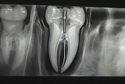 Xray Tooth Metal Post Byai