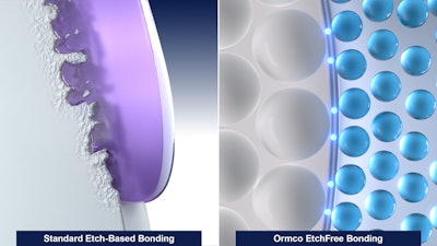 Ormco EtchFree bonding. Image courtesy of Ormco Corporation.