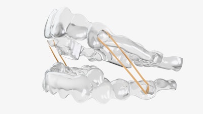 Ormco Spark aligner system. Images courtesy of Ormco Corporation.