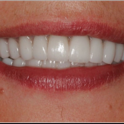 2025 05 01 Catapult Dentatus Fiber 400