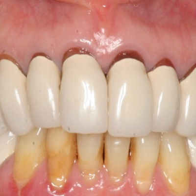 2025 05 01 Catapult Dentatus Fiber Bef 400