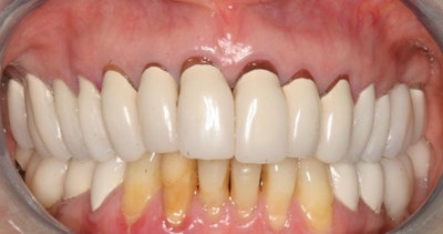Figure 1: A patient presented with a desire to have better aesthetics and an improved smile. Her present porcelain-fused-to-metal (PFM) restorations were completed several years ago in her home country. Radiographs indicated teeth #6-11 required retreatment of existing root canals. Images courtesy of Dr. Arthur (Tony) Tomaro.
