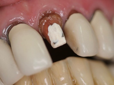 Figure 2: Upon removal of the first PFM, tooth #10 demonstrates what the remainder of #6-11 would consist of.