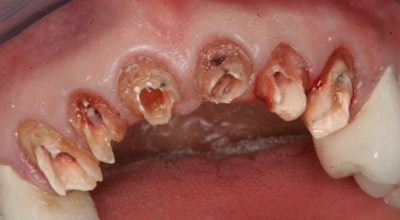 Figure 3: Post-root canal retreatment on #6-11, the canals were initially drilled with a Gates-Glidden #6, for an initial pilot pathway. This was followed by the placement of Dentatus Luscent-R Anchor reamers corresponding to the color of posts. The goal was to place the posts 75% down the canal.