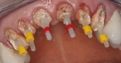 Figure 4: The image shows the post cemented with Kettenbach Visalys CemCore cement, a dual-cure cement, necessary due to curing light possibly not traveling to the apex of the posts. The canal was initially treated with the Visalys CemCore tooth primer for 20 seconds, then air-dried and paper-point dried. The posts were treated with Visalys CemCore restorative primer for one minute and air-dried. The cement completely set in five minutes.