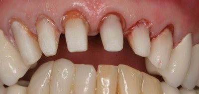 Figure 5: Final preparations with the best ferrule preps that could be accomplished. Cores were fabricated with Visalys CemCore with an opaque shade so the final restoration shade is not influenced by the core.