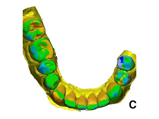 2025 05 03 3 D Printed Restorations 400